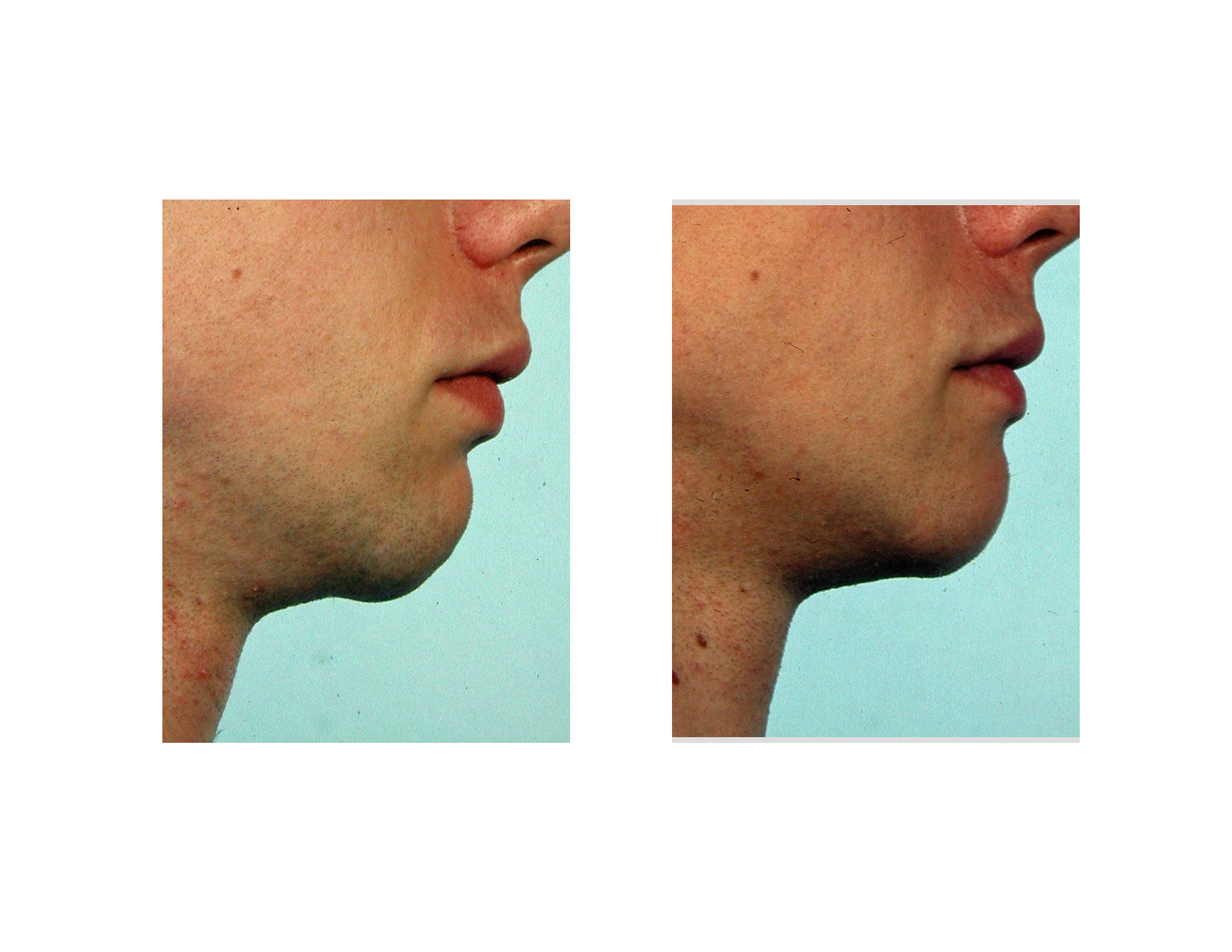 In the aged chin, in particular, the amount of chin projection is usually satisfactory. It is a matter of improving the soft tissue attachments to the bone. - correction-of-chin-sag-after-implant-removal-with-submental-tuck-up-and-new-small-implant