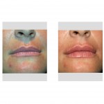 injectable-filler-lip-augmentation-dr-barry-eppley-indianapolis