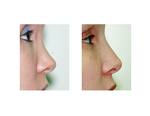 of rhinoplasty surgeries.