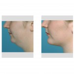 submentoplasty-dr-barry-eppley-indianapolis