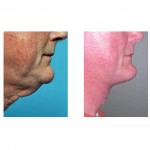 direct-necklift-immediate-result-dr-barry-eppley-indianapolis