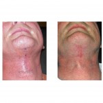 direct-necklift-scar-immediate-vs-three-months-dr-barry-eppley-indianapolis
