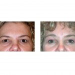 browlift-indianapolis-dr-barry-eppley