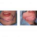 chin-scar-revisions-dr-barry-eppley-indianapolis