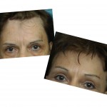combined-browlift-and-hairline-lowering-forehead-reduction-dr-barry-eppley-indianapolis