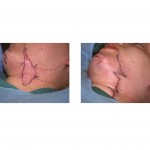 face-and-neck-scar-w-and-z-plasties-dr-barry-eppley-indianapolis