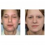 facial-scar-revision-dr-barry-eppley-indianapolis2