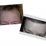 forehead-reduction-hairline-lowering-dr-barry-eppley-indianapolis