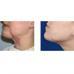 neck-scar-revision-dr-barry-eppley-indianapolis1