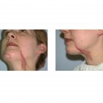 traumatic-facial-scarring-and-contracture-dr-barry-eppley-indianapolis