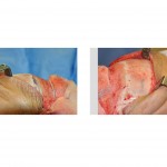 forehead-bone-reduction-dr-barry-eppley-indianapolis