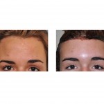 forehead-reduction-frontal-view-dr-barry-eppley-indianapolis