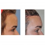 forehead-reduction-side-view-immediate-results-dr-barry-eplpey-indianapolis