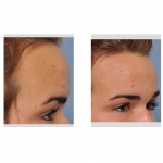 long-forehead-with-frontal-bulge-dr-barry-eppley-indianapolis