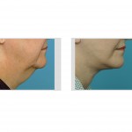 facelift-surgery-dr-barry-eppley-indianapolis