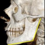 jaw-angle-dr-barry-eppley-indianapolis