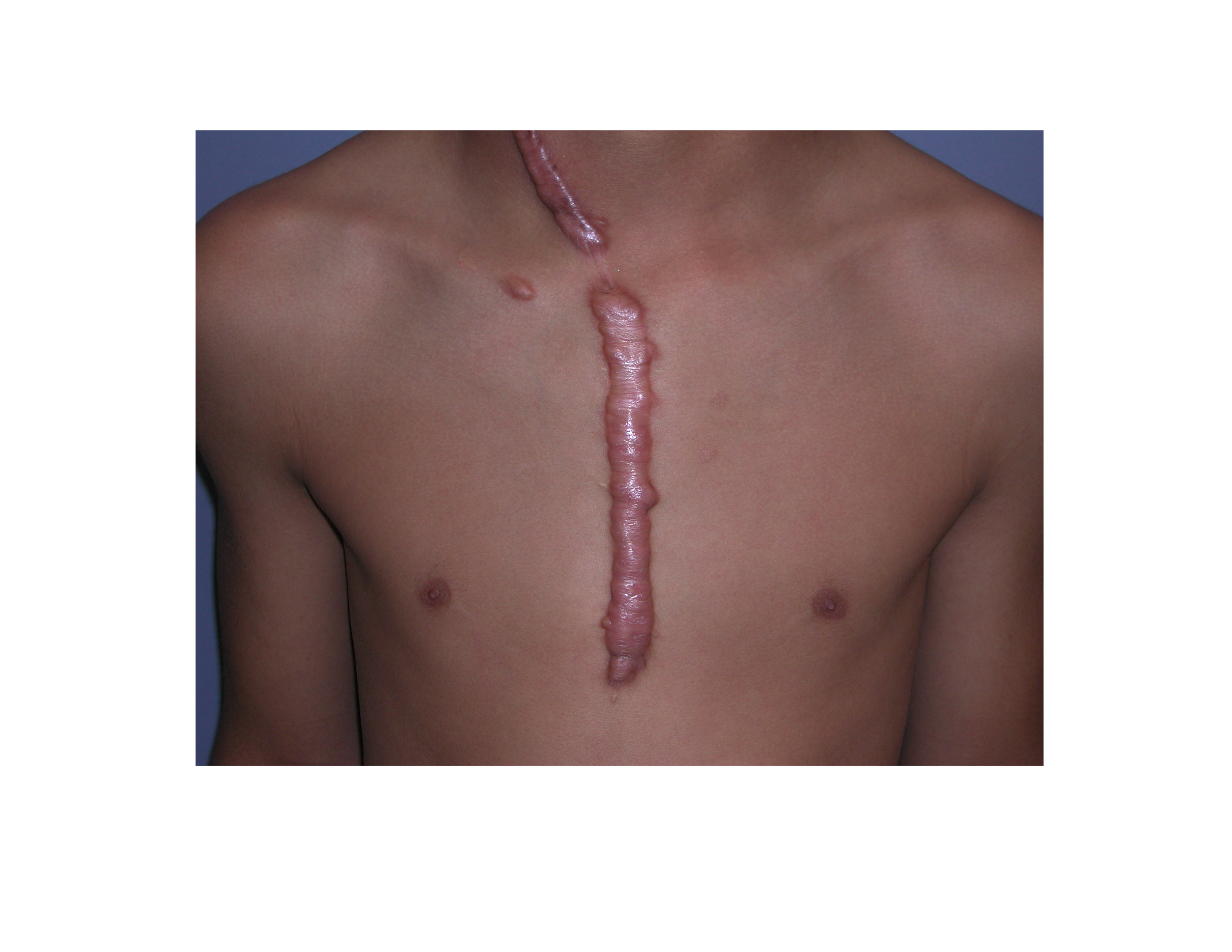 Keloid Scar Removal Surgery | www.pixshark.com - Images ...