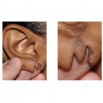 m-split-earlobe-deformity