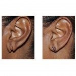 m-split-earlobe-repair-dr-barry-eppley-indianapolis