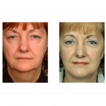 submentoplasty-after-facelift-dr-barry-eppley-indianapolis