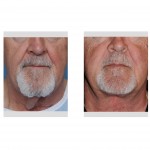 direct-necklift-result-frontal-view-dr-barry-eppley-indianapolis