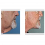 direct-necklift-result-side-view-dr-barry-eppley-indianapolis