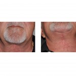 direct-necklift-scar-dr-barry-eppley-indianapolis