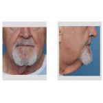 neck-wattles-in-older-men-dr-barry-eppley-indianapolis1