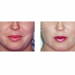 perioral-mound-reduction-in-round-face-dr-barry-eppley-indianapolis