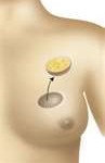 fat-injections-for-breast-lumpectomy-defects-dr-barry-eppley-indianapolis