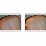 injectable-cranioplasty-left-side-view-dr-barry-eppley-indianapolis1