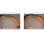 injectable-cranioplasty-right-side-view-dr-barry-eppley-indianapolis