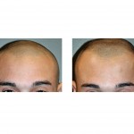 kryptonite-injectable-cranioplasty-front-view-dr-barry-eppley-indianapolis
