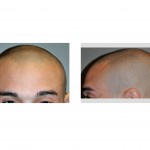 skull-deformiy-for-injectable-cranioplasty-dr-barry-eppley-indianapolis