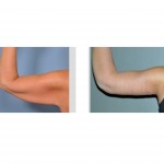 armlift-after-extreme-weight-loss-dr-barry-eppley-indianapolis