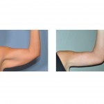 armlift-surgery-dr-barry-eppley-indianapolis