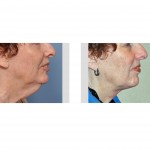 direct-necklift-in-a-female-dr-barry-eppley-indianapolis