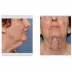 female-direct-necklift-cutout-pattern-dr-barry-eppley-indianapolis