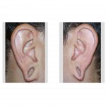 gauged-expanded-earlobes-dr-barry-eppley-indianapolis