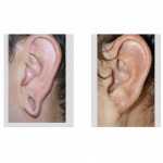 reconstruction-of-the-gauged-earlobe-dr-barry-eppley-indianapolis-left-ear