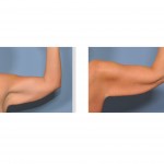 saggy-arms-arm-ptosis-dr-barry-eppley-indianapolis1