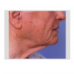 saggy-neck-older-male-dr-barry-eppley-indianapolis