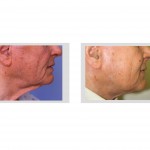 zipper-necklift-2-dr-barry-eppley-indianapolis