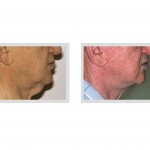 zipper-necklift-dr-barry-eppley-indianapolis