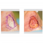 zipper-necklift-markings-dr-barry-eppley-indianapolis