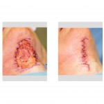 zipper-necklift-operation-dr-barry-eppley-indianapolis