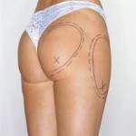 smartlipo-liposuction-dr-barry-eppley-indianapolis