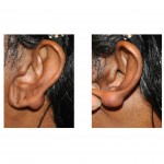 ear-keloid-dr-barry-eppley-indianapolis