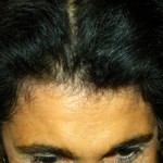 hairline-browlift-scar-dr-barry-eppley-indianapolis-plastic-surgery
