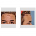 hairline-lower-forehead-reduction-surgical-plan-dr-barry-eppley-indianapolis